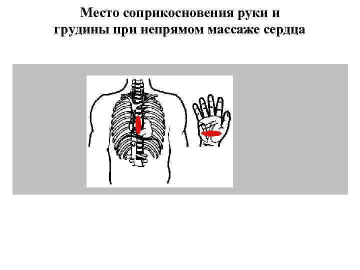 Место соприкосновения руки и грудины при непрямом массаже сердца 