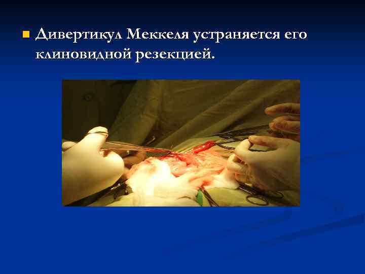 n Дивертикул Меккеля устраняется его клиновидной резекцией. 