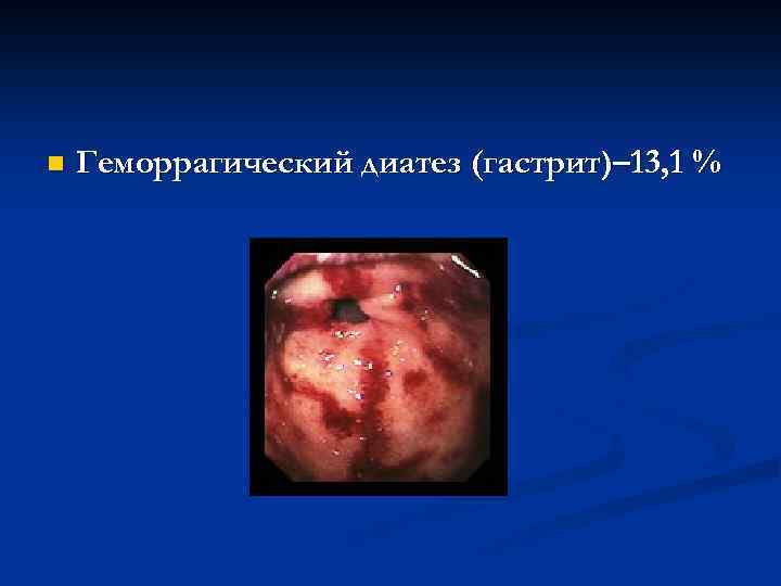 n Геморрагический диатез (гастрит)– 13, 1 % 