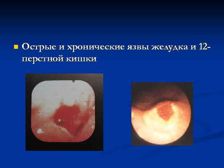 n Острые и хронические язвы желудка и 12 перстной кишки 