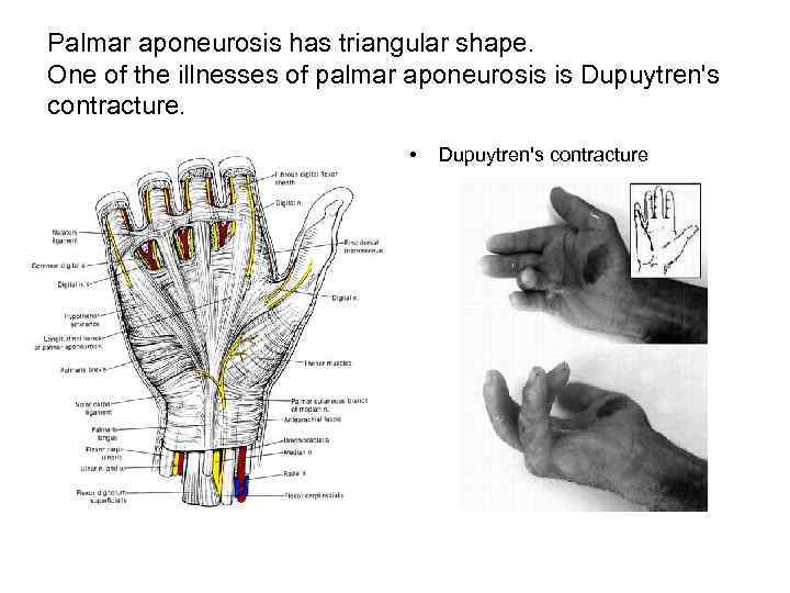 Palmar aponeurosis has triangular shape. One of the illnesses of palmar aponeurosis is Dupuytren's