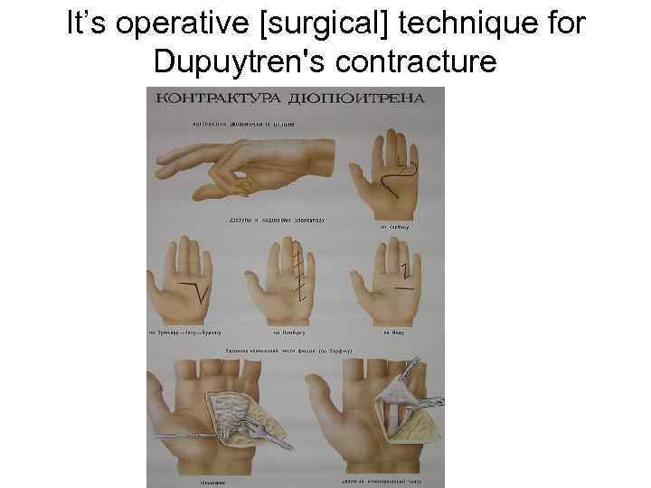 It’s operative [surgical] technique for Dupuytren's contracture 