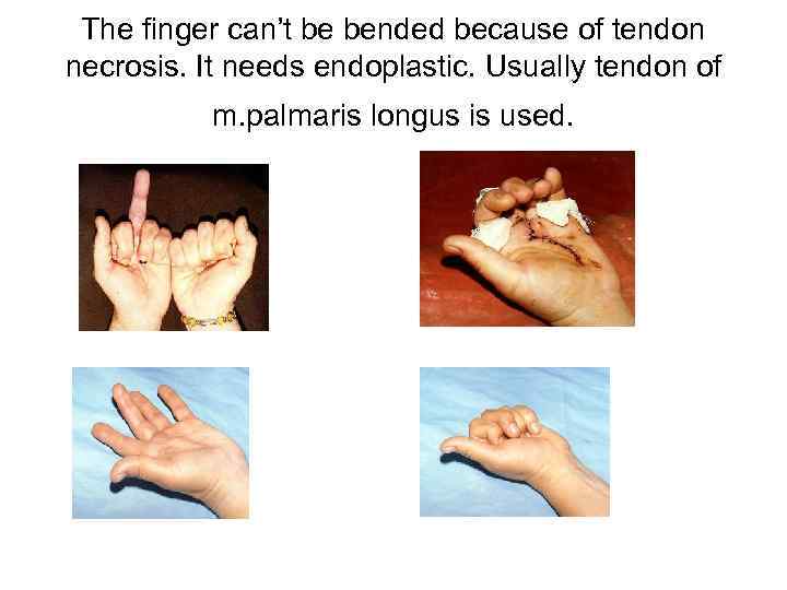 The finger can’t be bended because of tendon necrosis. It needs endoplastic. Usually tendon