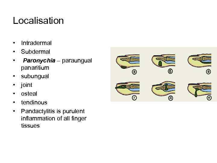 Localisation • Intradermal • Subdermal • Paronychia – paraungual panaritium • subungual • joint