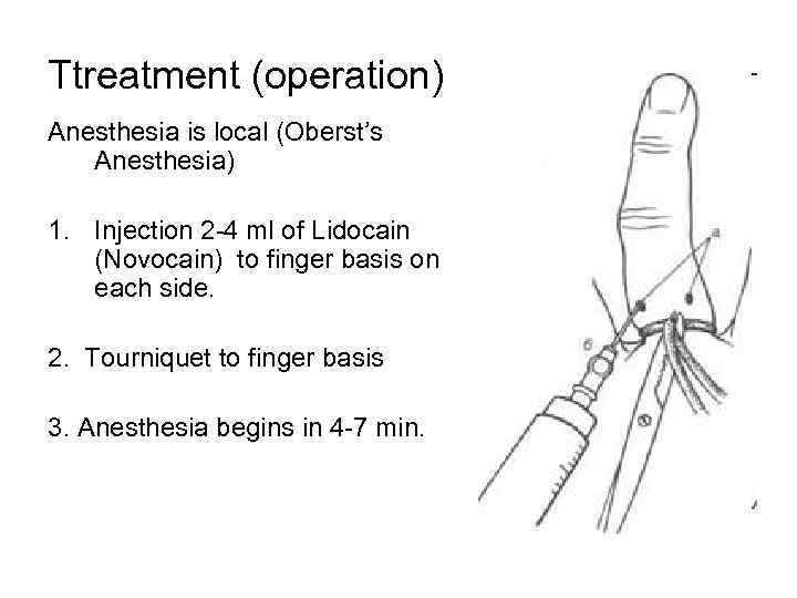 Ttreatment (operation) Anesthesia is local (Oberst’s Anesthesia) 1. Injection 2 -4 ml of Lidocain