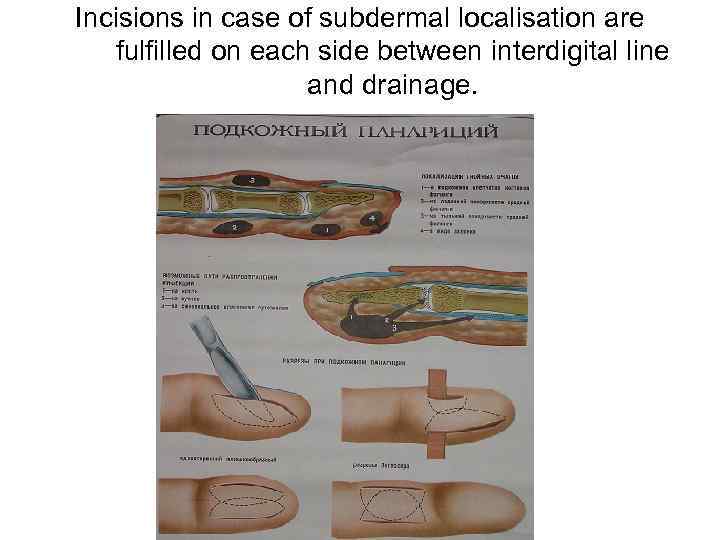 Incisions in case of subdermal localisation are fulfilled on each side between interdigital line