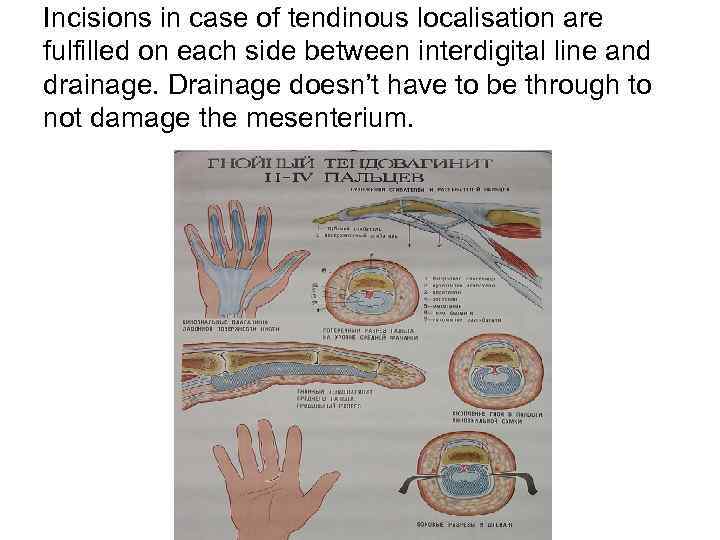 Incisions in case of tendinous localisation are fulfilled on each side between interdigital line