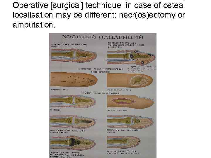 Operative [surgical] technique in case of osteal localisation may be different: necr(os)ectomy or amputation.