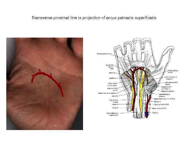 Transverse proximal line is projection of arcus palmaris superficialis 