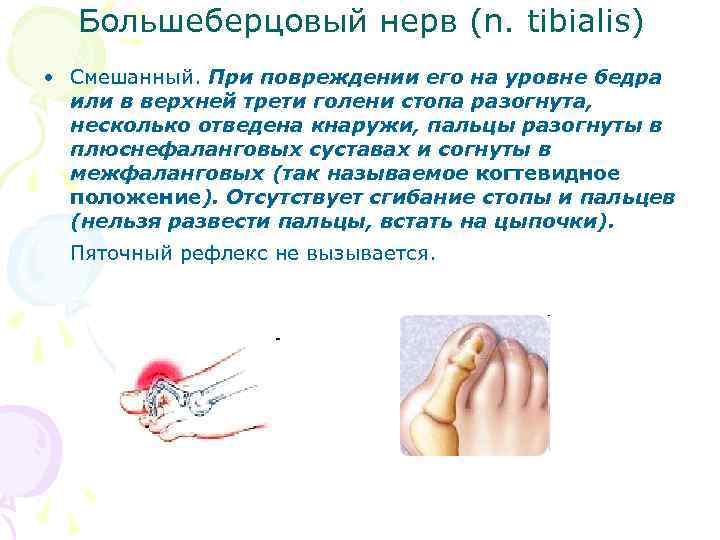 Большеберцовый нерв (n. tibialis) • Смешанный. При повреждении его на уровне бедра или в