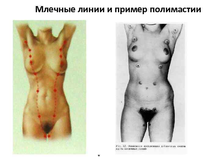 Млечные линии и пример полимастии * 