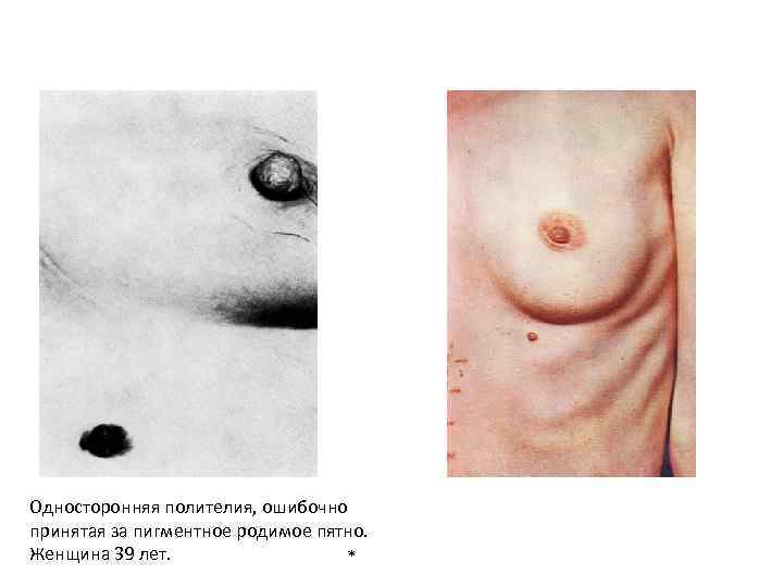 Односторонняя полителия, ошибочно принятая за пигментное родимое пятно. Женщина 39 лет. * 