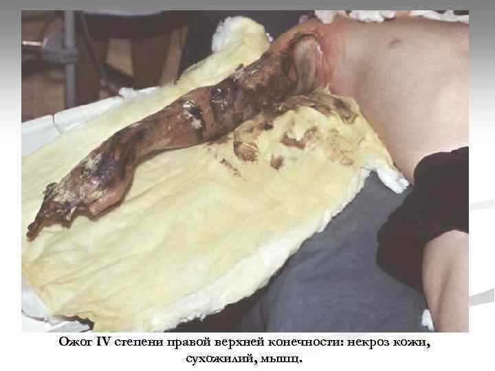 Ожог IV степени правой верхней конечности: некроз кожи, сухожилий, мышц. 