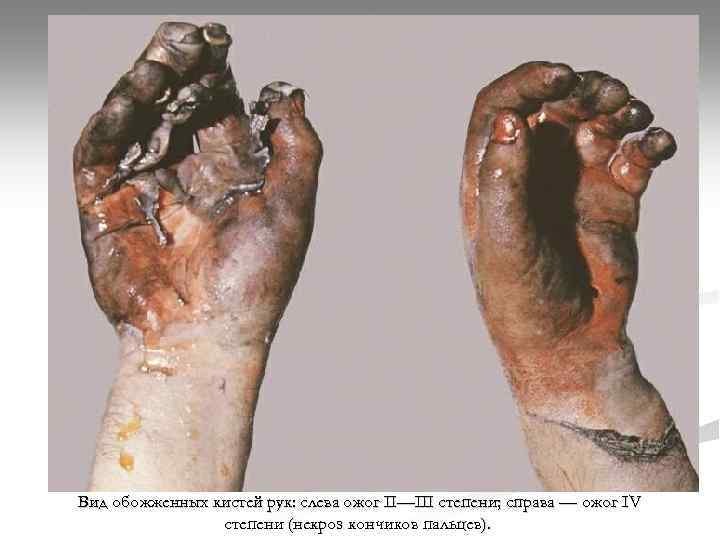 Вид обожженных кистей рук: слева ожог II—III степени; справа — ожог IV степени (некроз