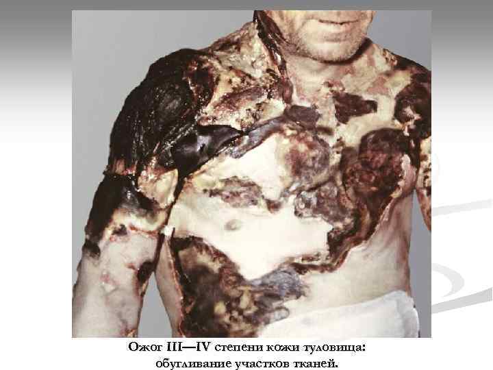Ожог III—IV степени кожи туловища: обугливание участков тканей. 