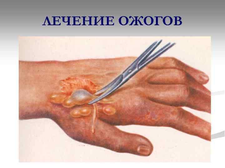 ЛЕЧЕНИЕ ОЖОГОВ 