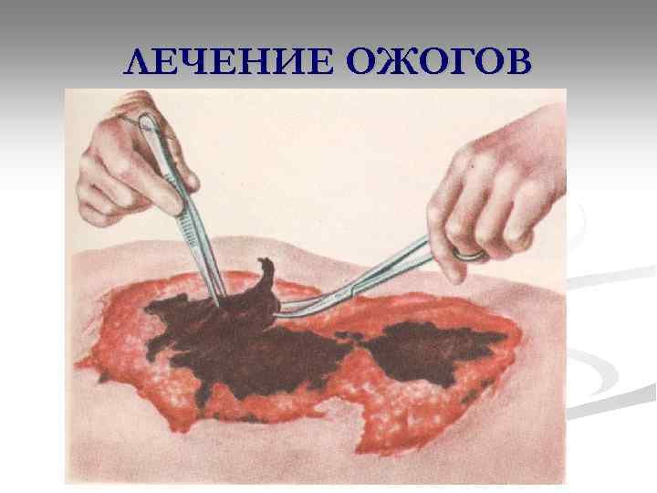 ЛЕЧЕНИЕ ОЖОГОВ 