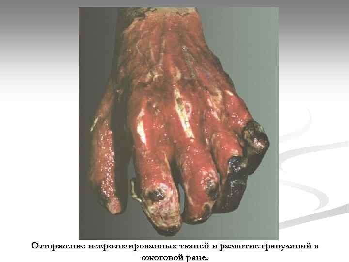 Отторжение некротизированных тканей и развитие грануляций в ожоговой ране. 