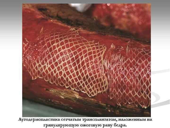 Аутодермопластика сетчатым трансплантатом, наложенным на гранулирующую ожоговую рану бедра. 
