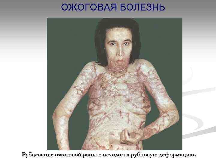 ОЖОГОВАЯ БОЛЕЗНЬ Рубцевание ожоговой раны с исходом в рубцовую деформацию. 