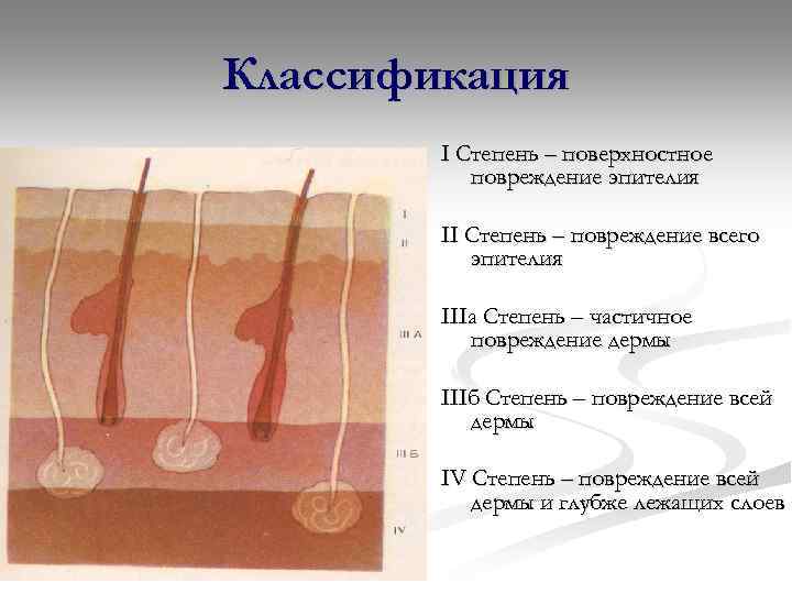 Классификация I Степень – поверхностное повреждение эпителия II Степень – повреждение всего эпителия IIIа