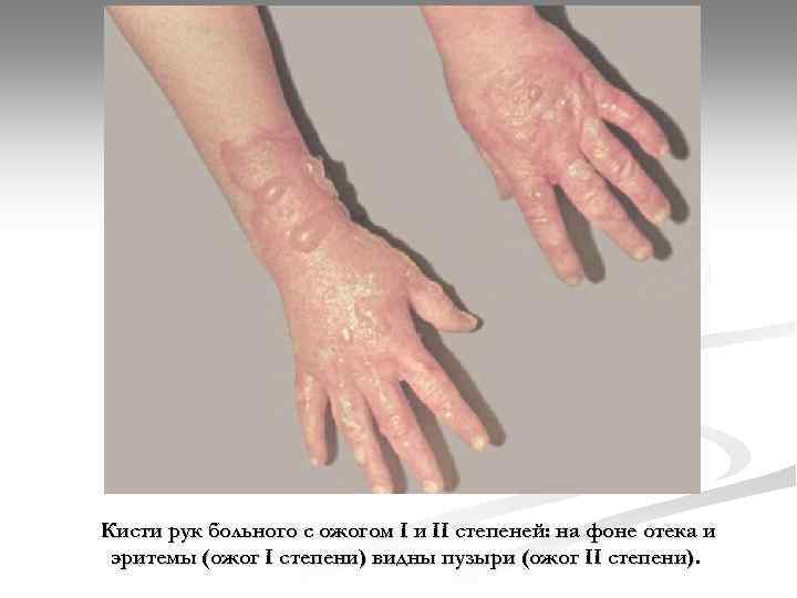 Кисти рук больного с ожогом I и II степеней: на фоне отека и эритемы