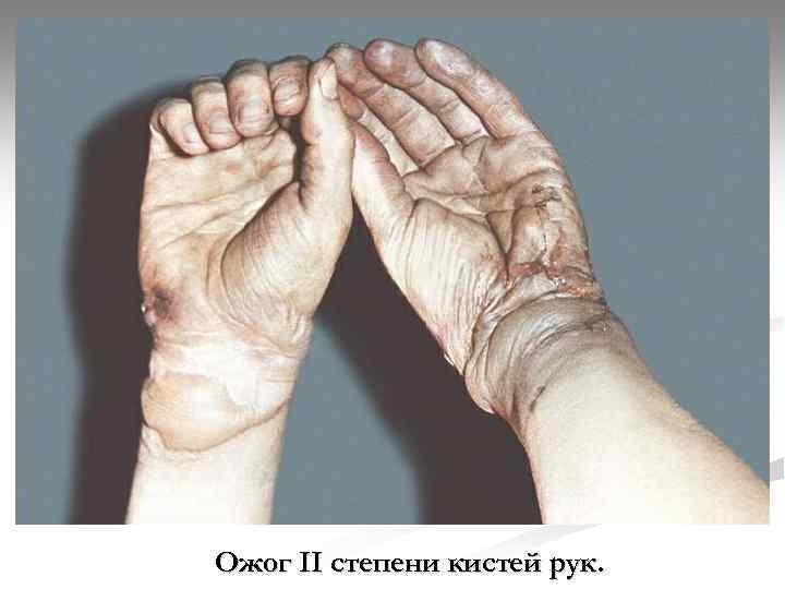 Ожог II степени кистей рук. 
