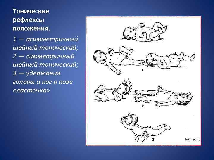 Тонические рефлексы положения. 1 — асимметричный шейный тонический; 2 — симметричный шейный тонический; 3