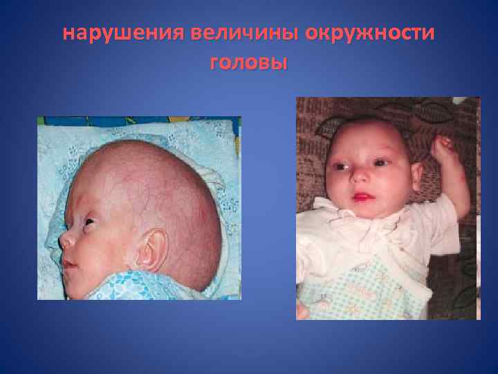 нарушения величины окружности головы 