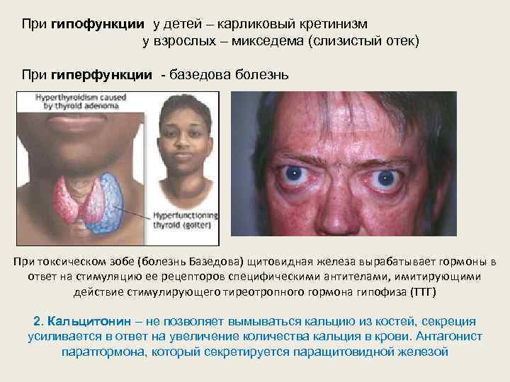 При гипофункции у детей – карликовый кретинизм у взрослых – микседема (слизистый отек) При