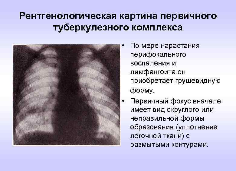 Первичный туберкулез. Пневмоническая фаза первичного туберкулезного комплекса. Первичный туберкулезный комплекс очаг гона. Рентген картина первичного туберкулезного комплекса. Первичный туберкулезный комплекс в фазе рассасывания.