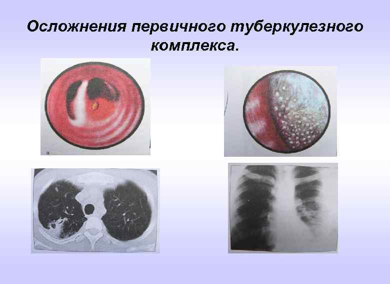 Осложнения первичного туберкулезного комплекса. 