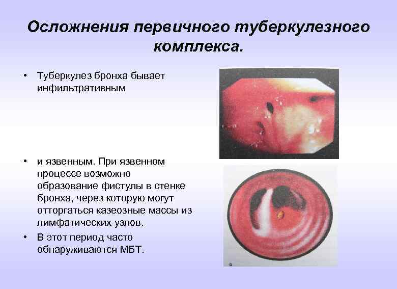 Осложнения первичного туберкулезного комплекса. • Туберкулез бронха бывает инфильтративным • и язвенным. При язвенном