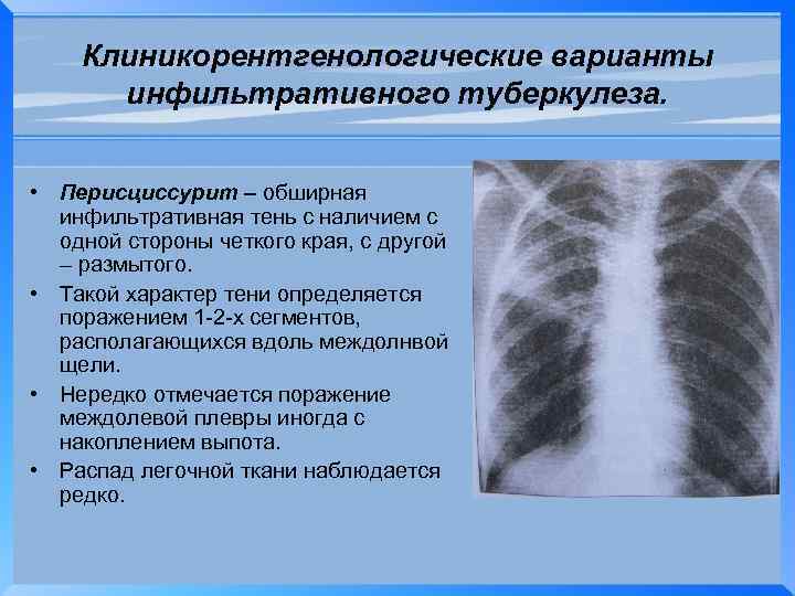 Клиникорентгенологические варианты инфильтративного туберкулеза. • Перисциссурит – обширная инфильтративная тень с наличием с одной
