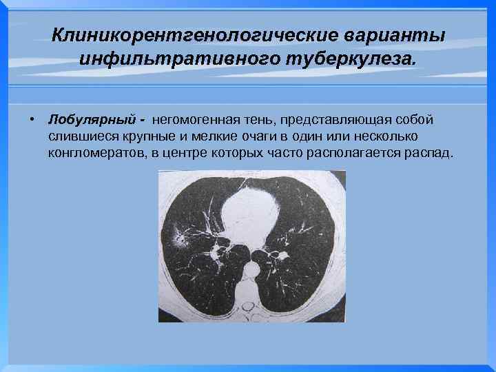 Клиникорентгенологические варианты инфильтративного туберкулеза. • Лобулярный - негомогенная тень, представляющая собой слившиеся крупные и