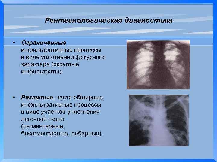Рентгенологическая диагностика • Ограниченные инфильтративные процессы в виде уплотнений фокусного характера (округлые инфильтраты). •