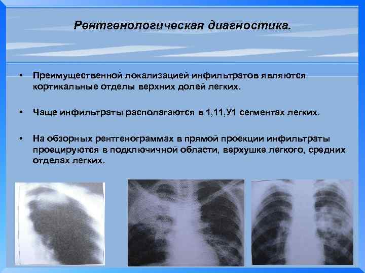 Рентгенологическая диагностика. • Преимущественной локализацией инфильтратов являются кортикальные отделы верхних долей легких. • Чаще