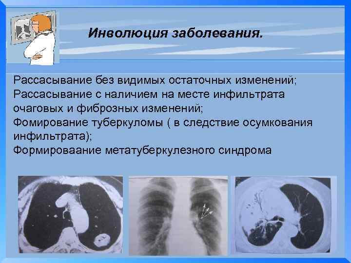 Инволюция заболевания. Рассасывание без видимых остаточных изменений; Рассасывание с наличием на месте инфильтрата очаговых