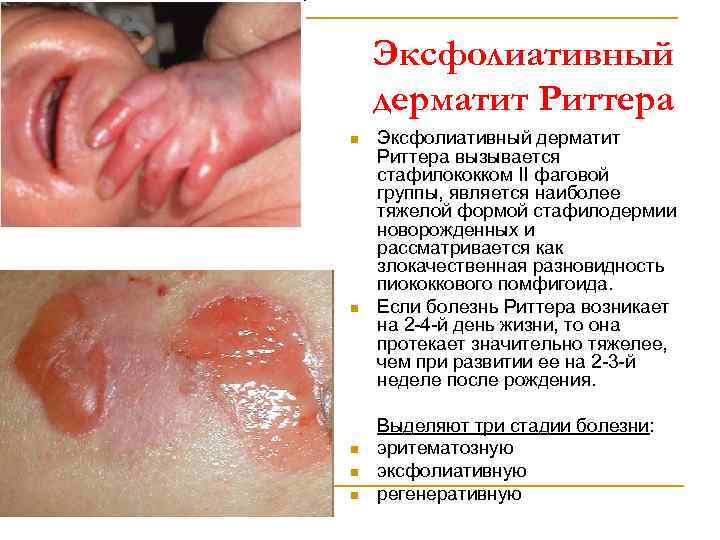 Эксфолиативный дерматит Риттера n n n Эксфолиативный дерматит Риттера вызывается стафилококком II фаговой группы,