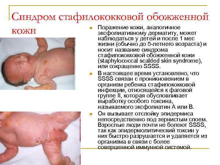 Синдром стафилококковой обожженной Поражение кожи, аналогичное кожи эксфолиативному дерматиту, может n n n наблюдаться