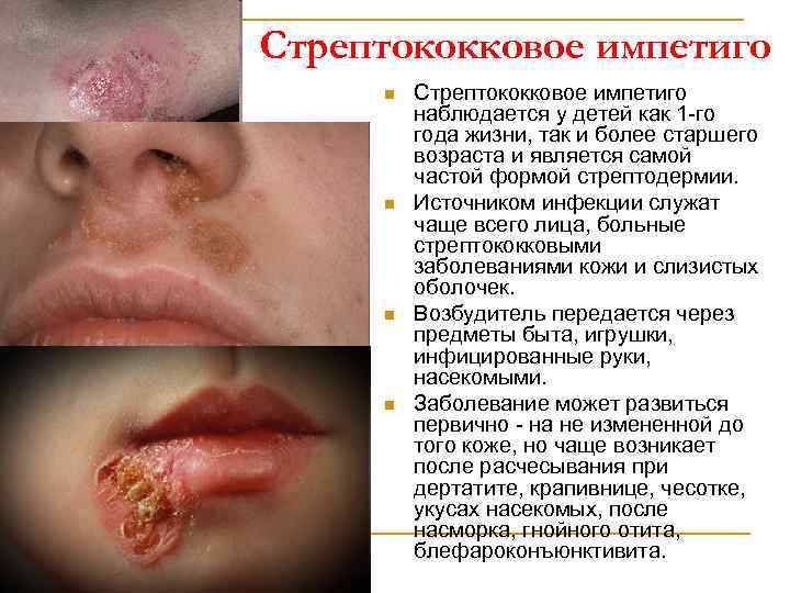 Стрептококковое импетиго n n Стрептококковое импетиго наблюдается у детей как 1 -го года жизни,