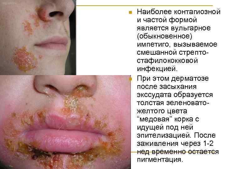 n n Наиболее контагиозной и частой формой является вульгарное (обыкновенное) импетиго, вызываемое смешанной стрептостафилококковой