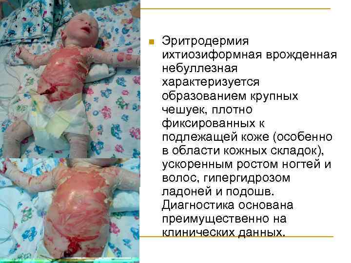 n Эритродермия ихтиозиформная врожденная небуллезная характеризуется образованием крупных чешуек, плотно фиксированных к подлежащей коже