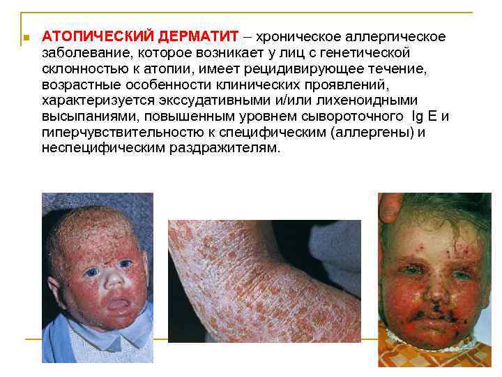 n АТОПИЧЕСКИЙ ДЕРМАТИТ – хроническое аллергическое заболевание, которое возникает у лиц с генетической склонностью