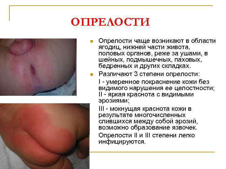 ОПРЕЛОСТИ n n Опрелости чаще возникают в области ягодиц, нижней части живота, половых органов,