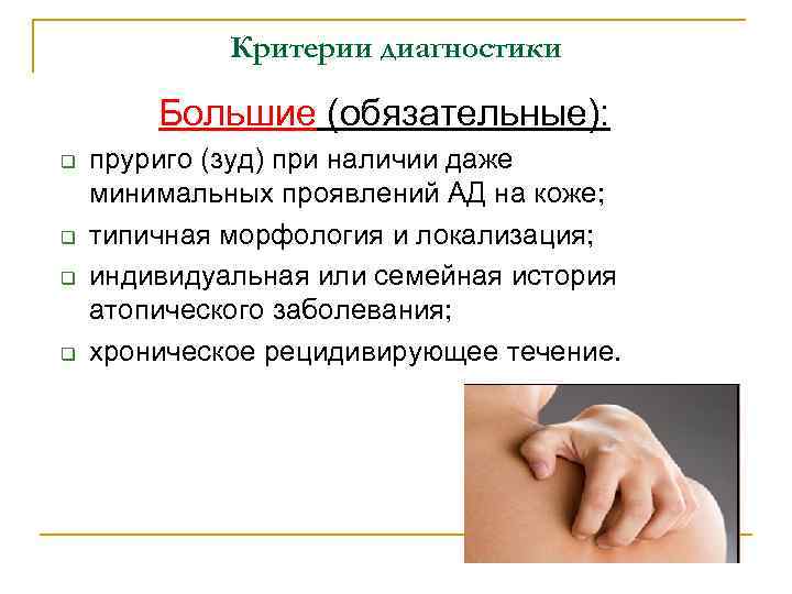 Критерии диагностики Большие (обязательные): q q пруриго (зуд) при наличии даже минимальных проявлений АД