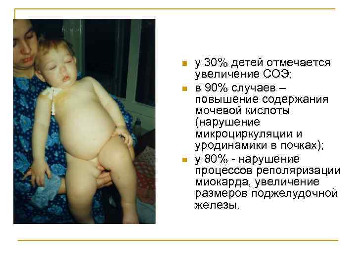 n n n у 30% детей отмечается увеличение СОЭ; в 90% случаев – повышение