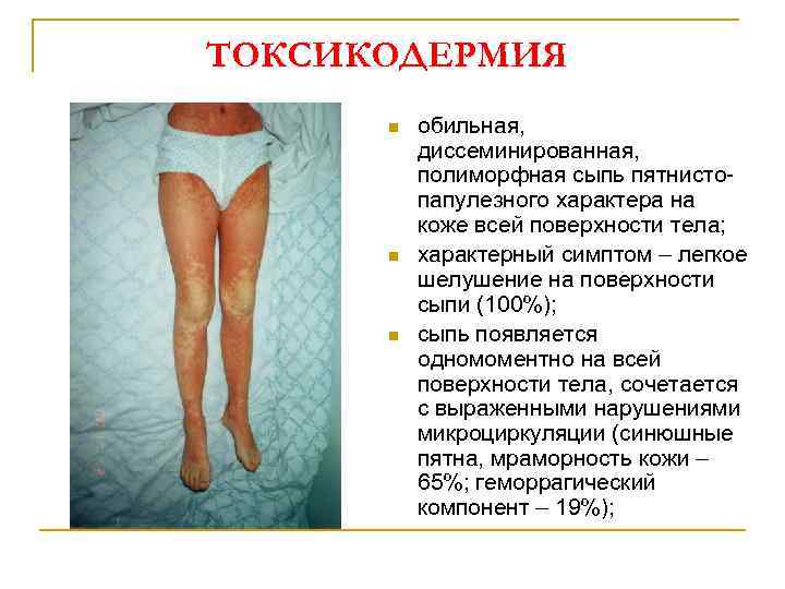 ТОКСИКОДЕРМИЯ n n n обильная, диссеминированная, полиморфная сыпь пятнистопапулезного характера на коже всей поверхности
