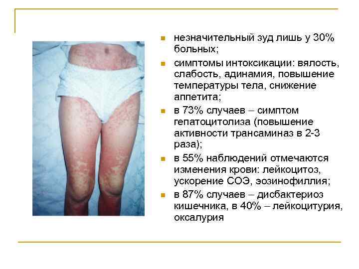 n n n незначительный зуд лишь у 30% больных; симптомы интоксикации: вялость, слабость, адинамия,