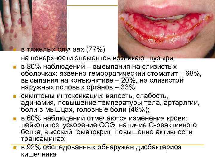 n n n в тяжелых случаях (77%) на поверхности элементов возникают пузыри; в 80%